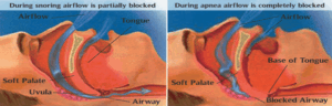 Sleep Apnea Dr. W. Gray Grieve Orthodontics Eugene OR