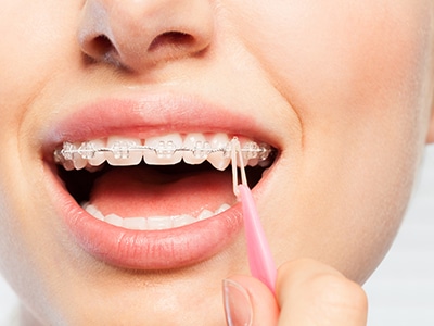 blog-featured-image-elastics-and-orthodontic-treatment