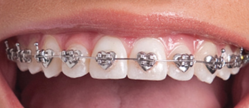 Types of braces at Dr. W. Gray Grieve Orthodontics in Eugene, OR