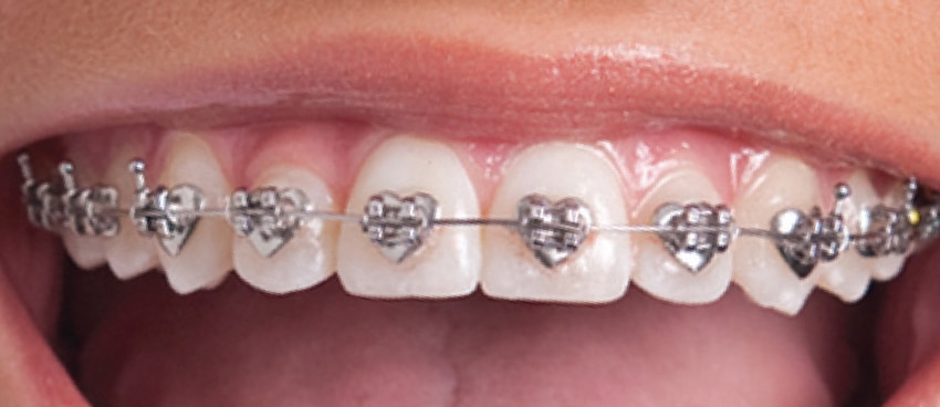 FAQ About Braces and Invisalign Eugene OR Dr W Gray Grieve