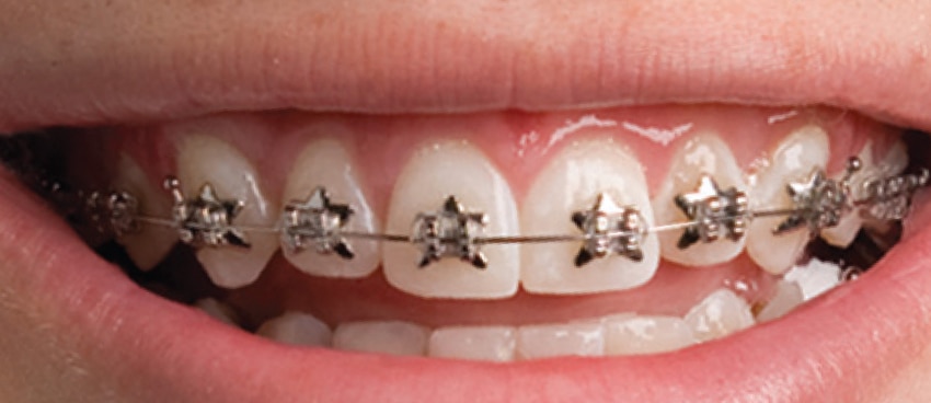 Metal Braces vs Invisible Braces – What's Better for you - Stuart Curry DMD