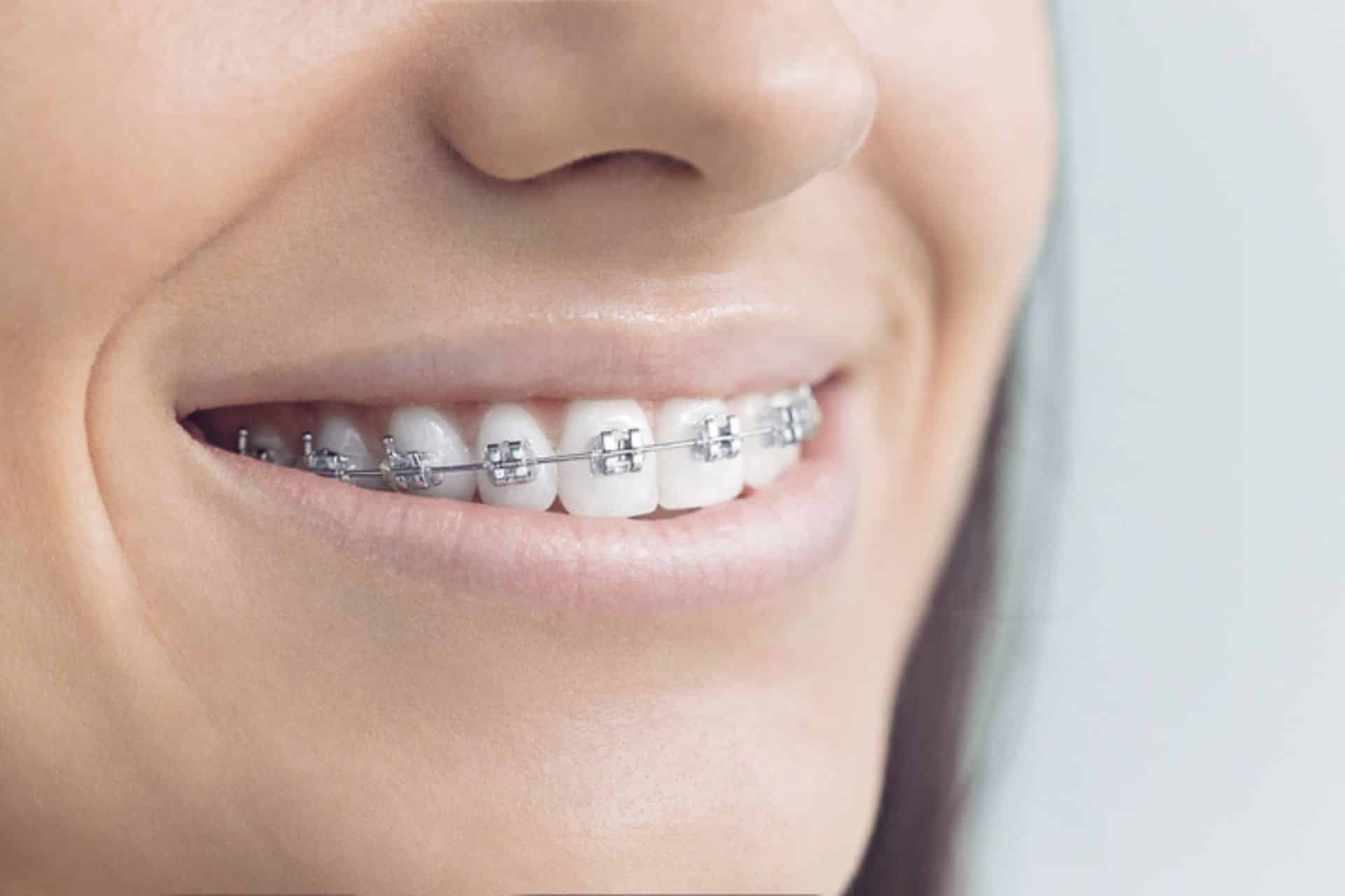 Can I Switch Orthodontists During Treatment? Dr. W. Gray Grieve Orthodontics in Eugene, OR