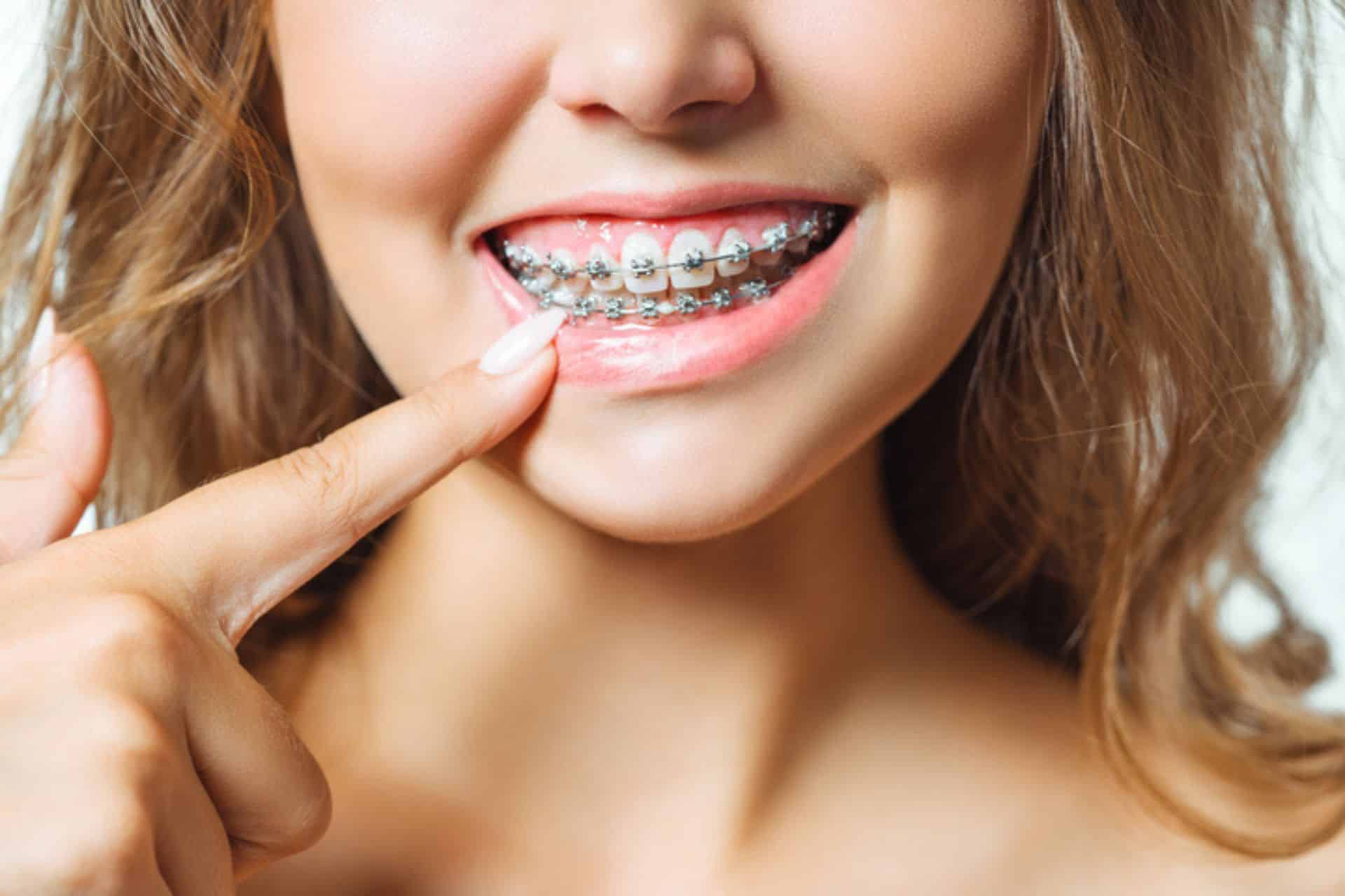 What Foods Should You Avoid With Braces? Dr. W. Gray Grieve Orthodontics in Eugene, OR