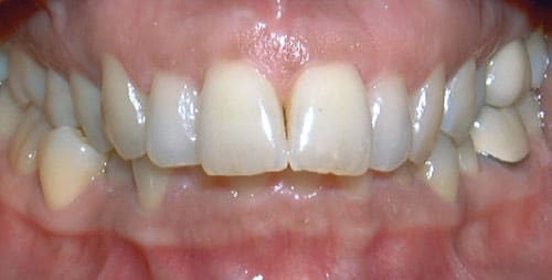 Close-up front view of an overbite showing upper front teeth overlapping the lower front teeth before orthodontic correction, Dr. W. Gray Grieve Orthodontics, Eugene, OR
