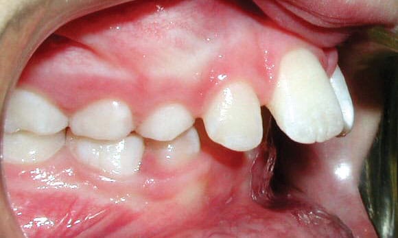 Close-up side view of upper front teeth protrusion showing front teeth extending forward before orthodontic correction, Dr. W. Gray Grieve Orthodontics, Eugene, OR