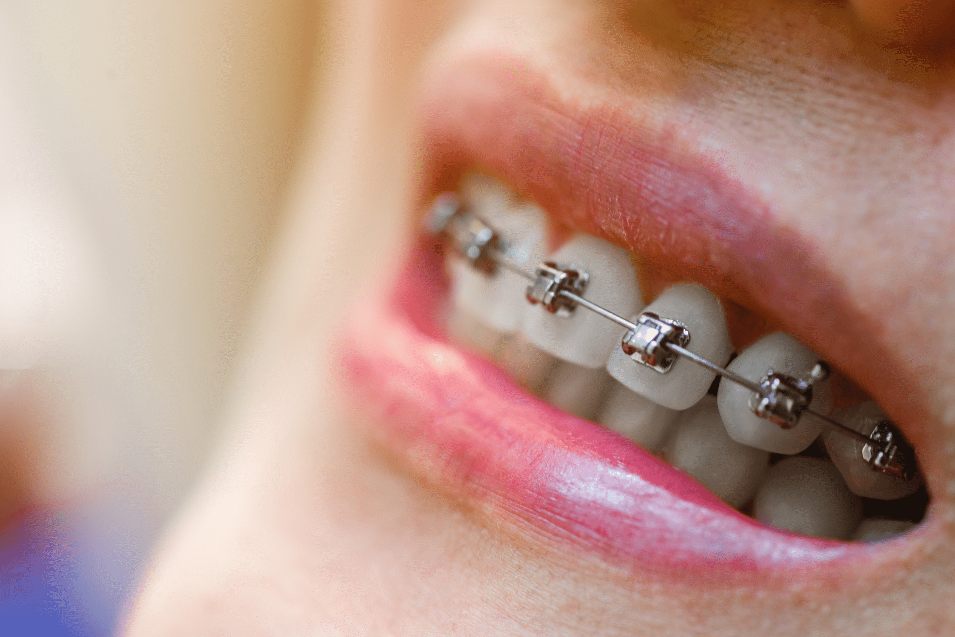 Close-up side view of a person smiling with metal braces.